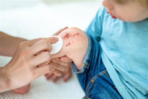 Pediatric Wound Care 6 Key Points To Remember