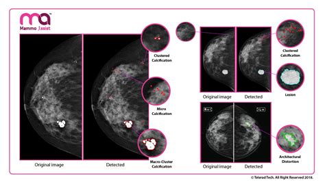 Telerad Tech Launches Ai Product For Early Stage Breast Cancer Detection
