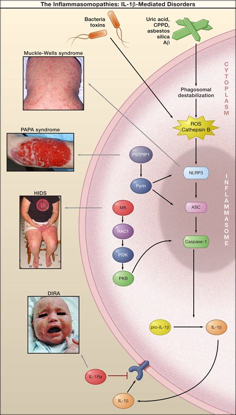 Autoinflammatory Disease Reloaded A Clinical Perspective Cell
