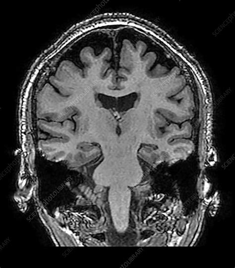 Mesial Temporal Sclerosis Mri Stock Image C0394239 Science