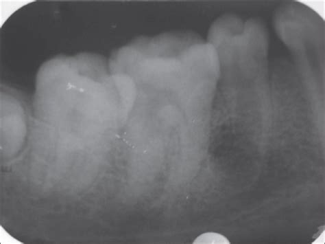 Iopa Radiograph Pre Op Showing Blunderbuss Apex And Large Periapical