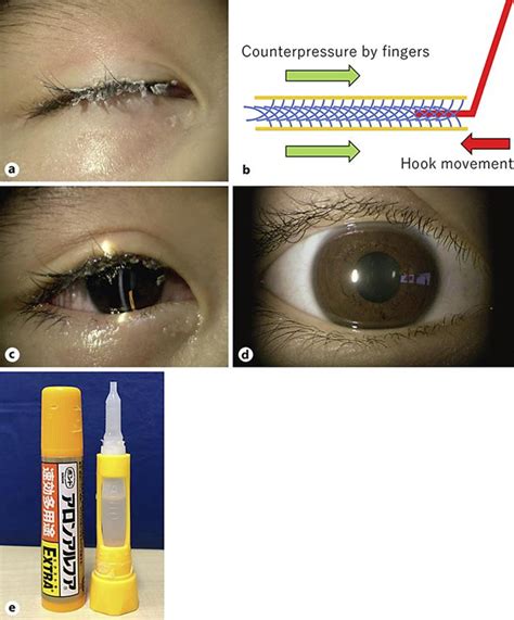 Figure 1 From A Case Of Pediatric Cyanoacrylate Adhesive Injury To The