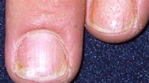 Impact Of Nail Psoriasis On Psoriatic Arthritis Rheumnow