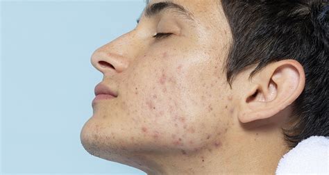 Does Masturbation Cause Acne Stop Together