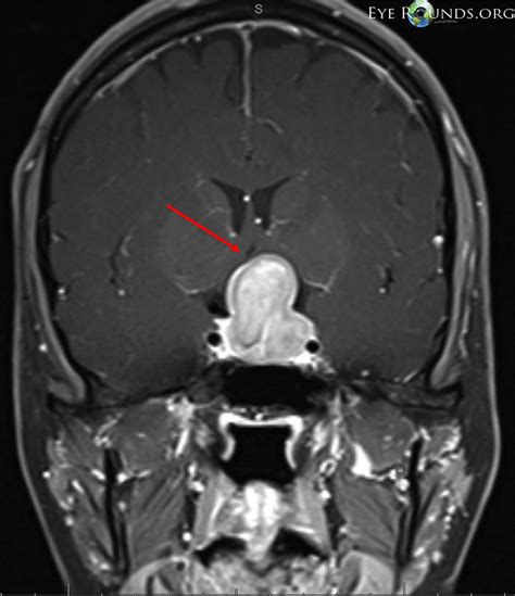 Pituitary Adenoma Causing Compression Of The Optic Chiasm The