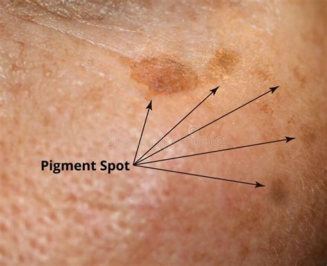 Brown Spot On The Skin Of The Face Pigmentation On The Skin Stock