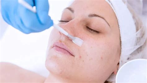 Chemical Peel For Acne Scars Procedure And Benefits 7dmc Dubai