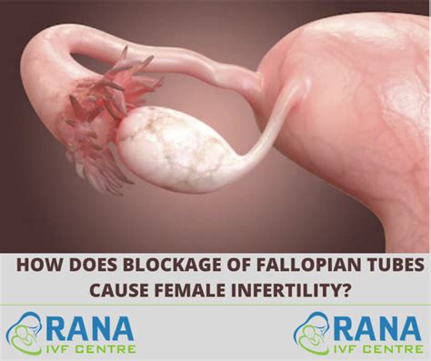 How Does Blockage Of Fallopian Tubes Cause Female Infertility