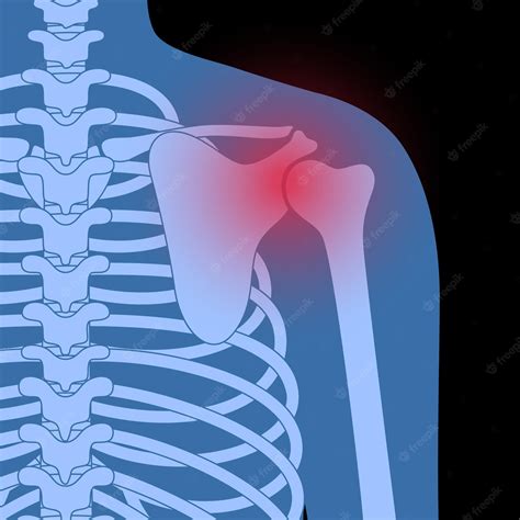 Premium Vector Pain In Shoulder Or Scapula Skeleton X Ray Silhouette
