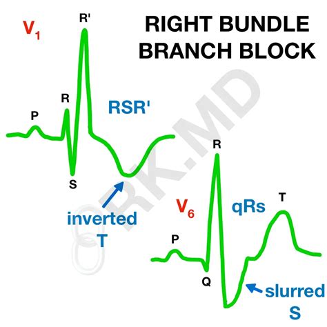 Right Bundle Branch Block Ekg Findings Rk Md