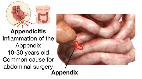 Appendicitis Pain Symptoms Signs Causes Diagnosis Treatment EZmed