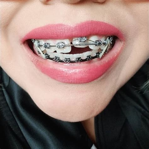 The Best Braces Color Ideas For Spring
