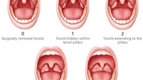 Tonsil Cancer Causes Symptoms Prognosis And Treatment Woms