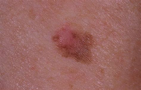 What Is Melanoma And What Are The Early Signs Of The Skin Cancer The