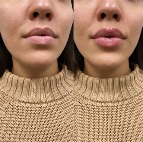 lip fillers injections upper east side nyc neinstein plastic surgery