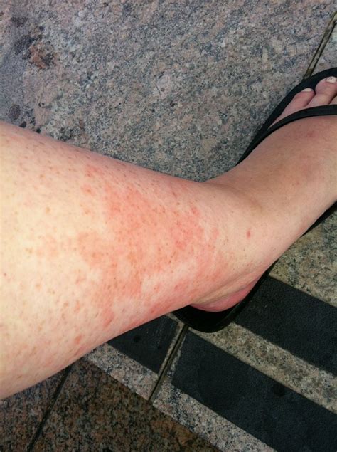Leg Rashes In Adults Vasculitis Tell The It Because Few Bumps On Sexiezpicz Web Porn