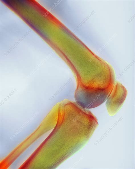 Healthy Knee X Ray Stock Image P1160503 Science Photo Library