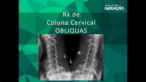 Radiografia Da Coluna Cervical Obliquas YouTube