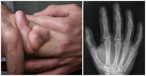 Is Cracking Your Knuckles Actually Good For You