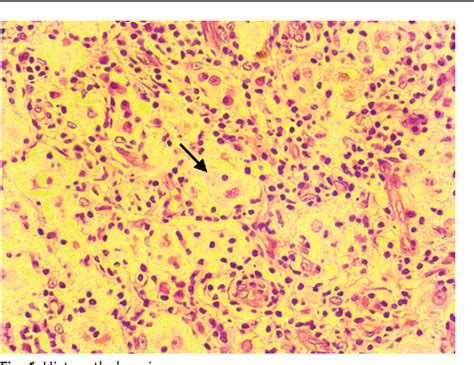 Figure 6 From A Rare Case Of Rosai Dorfman Disease In Calcaneum And
