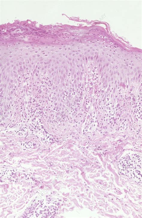 We did not find results for: Reiter's Syndrome, LM - Stock Image - C050/2033 - Science ...