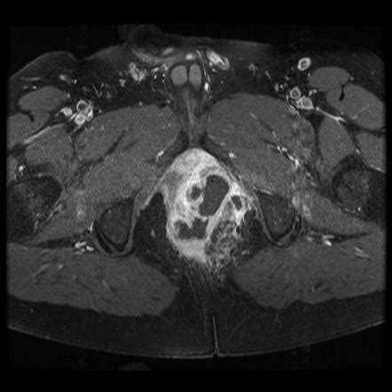 Perianal Abscess Radiology Reference Article Radiopaedia Org Hot Sex