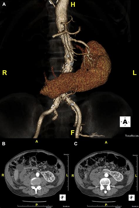Aspiration Thrombectomy Of Acute Atrial Fibrillation Related Renal