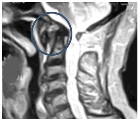 Diagnostics Free Full Text C1 C2 Rotatory Subluxation In Adults “a