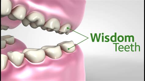 Symptoms And Signs That Your Wisdom Teeth Are Coming In Boston