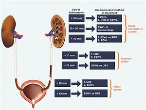 Kidney Stones And Treatment Methods Dornier Medtech Americas