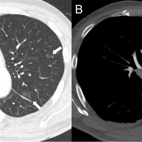 Chest Computed Tomography Images A Chest Computed Tomography Ct