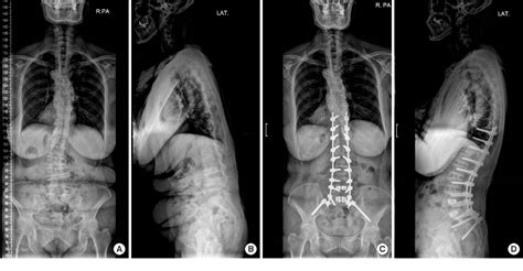 Figure 1 From Minimally Invasive Spinal Surgery For Adult Spinal
