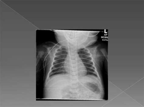 Neonatal Chest X Ray Reading