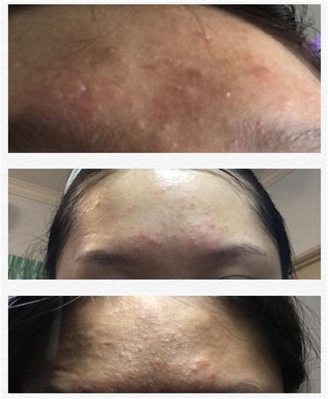 If you can't find relief for your fungal acne breakouts, then talk to a. Is this fungal acne? Tried nizoral but it doesn't work ...