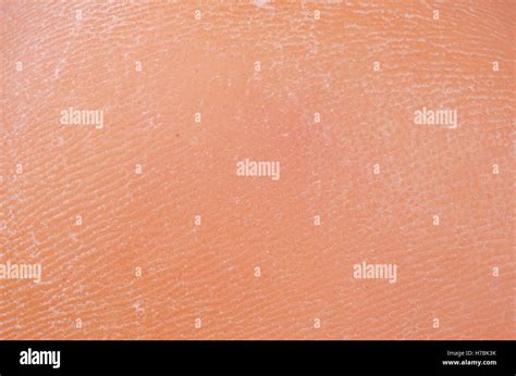 Cracked Skin Leg Hi Res Stock Photography And Images Alamy