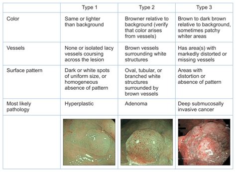 Mucosal Imaging In Colon Polyps New Advances And What The Future May Hold
