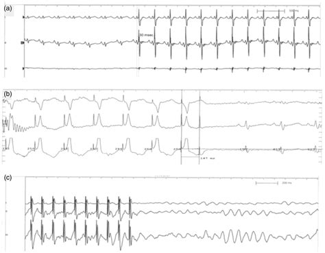 Effect Of Cardiac Contractility Modulation On Myocardial Download