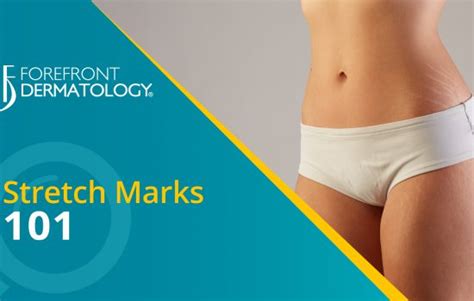 Stretch Marks 101 Dermspecialists