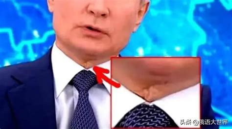 The Scar On Putin S Neck Sparked Conjecture Has He Undergone A