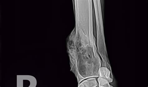Osteosarcoma In Dogs Petcoach