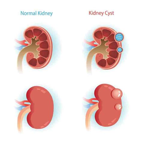 Kidney Cysts Finding From Medical Checkup Do We Need To Take It Seriously