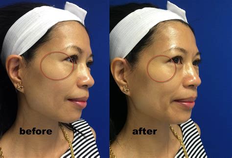 Generally, if more melanin is present, the color of the hair is darker; HydraFacial MD® Before and After | Hydrafacial before ...