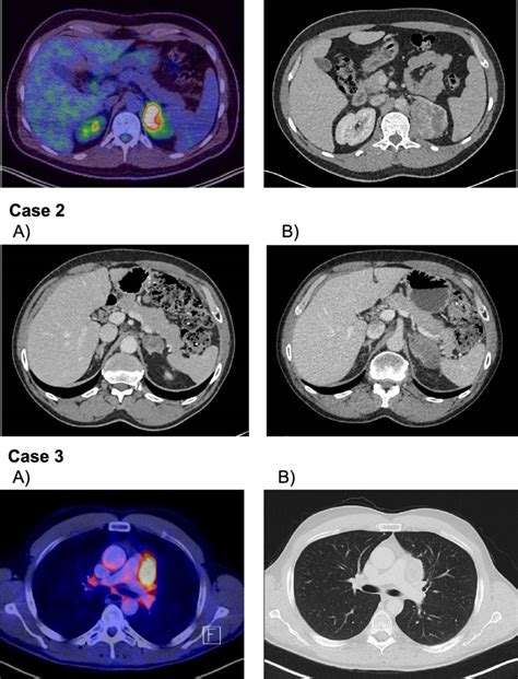 Radiological Imaging Of Large Adrenocortical Lesions Before Surgery Or