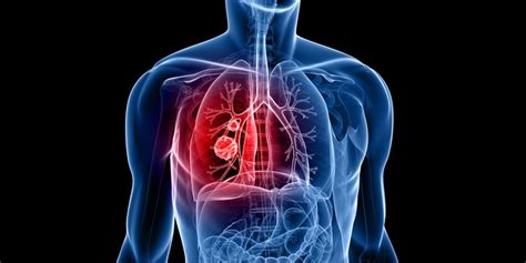 Lung cancer usually has no symptoms in its early stages. 8 Signs and Symptoms of Lung Cancer That Will Surprise You