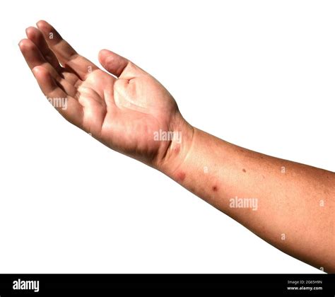 Rashes And Red Blisters On The Skin Of Human Arm And Hand Islated On
