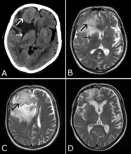 Large Right Frontal Intracranial Tumour Large Arrows With Surrounding