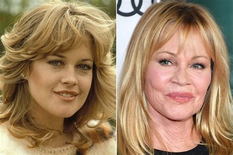 Celebs Who Are Unrecognizable After Having Plastic Surgery Page 37 Of