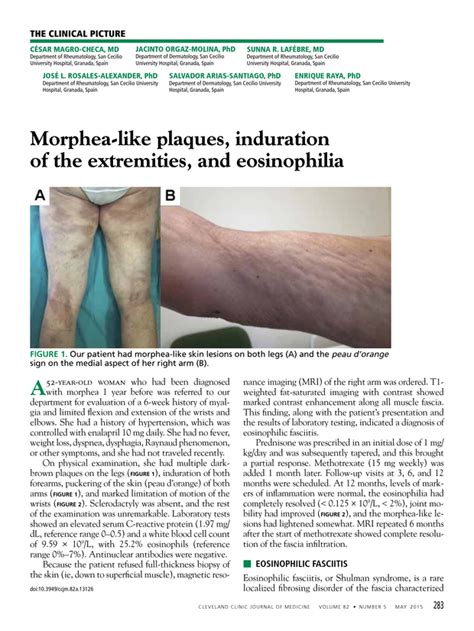 Morphea Like Plaques Induration Of The Extremities And Eosinophilia