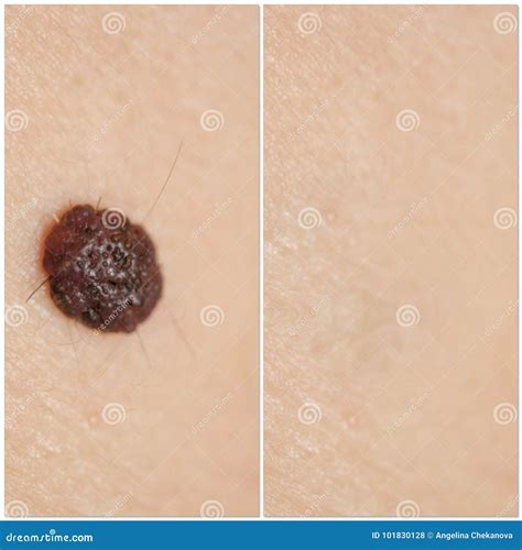 Laser Removal Of Moles View Before And After Stock Photo Image Of