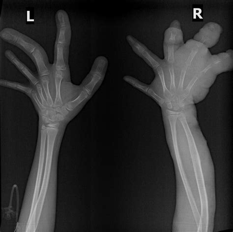 Klippel Trénaunay Weber Syndrome Radiology Case